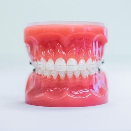 clear braces on plastic model