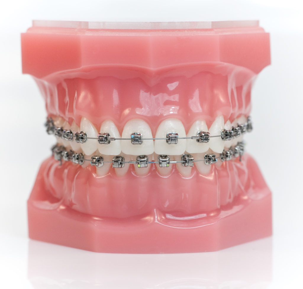 Braces & Invisalign Erie PA